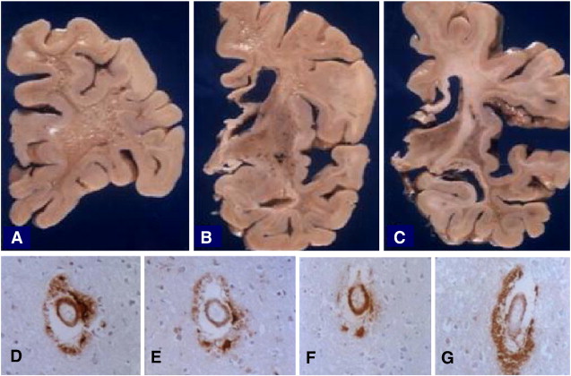 Vaskulāras demences risks īpaši augsts pacientiem ar 2. tipa cukura diabētu