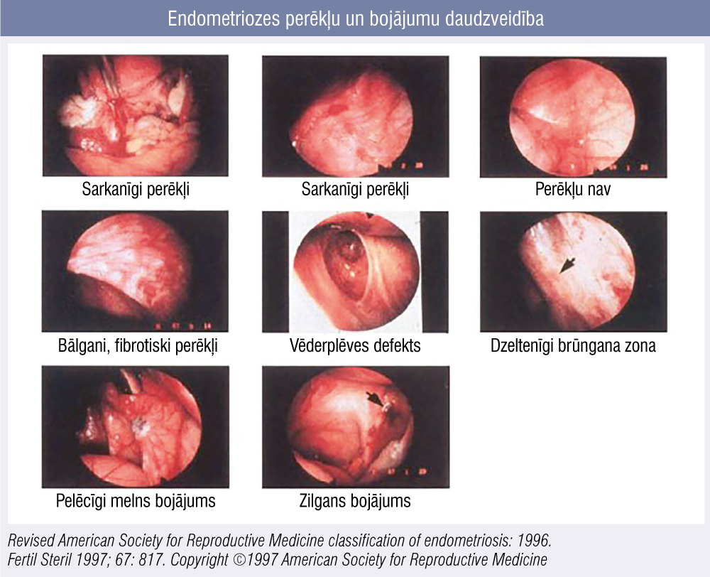 Endometriozes perēkļu un bojājumu daudzveidība