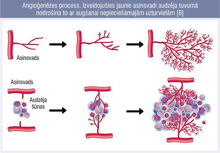 Angioģenēzes process. Izveidojušies jaunie asinsvadi audzēja tuvumā nodrošina to ar augšanai nepieciešamajām uzturvielām [8]