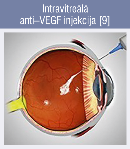 Intravitreālā anti–VEGF injekcija [9]