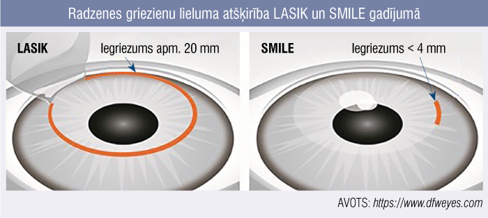 Radzenes griezienu lieluma atšķirība LASIK un SMILE gadījumā