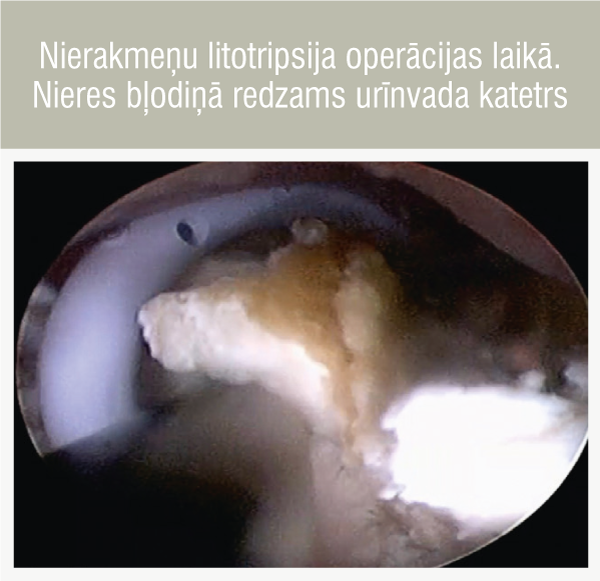 Nierakmeņu litotripsija operācijas laikā. Nieres bļodiņā redzams urīnvada katetrs