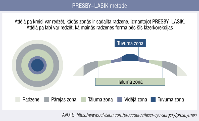PRESBY–LASIK metode