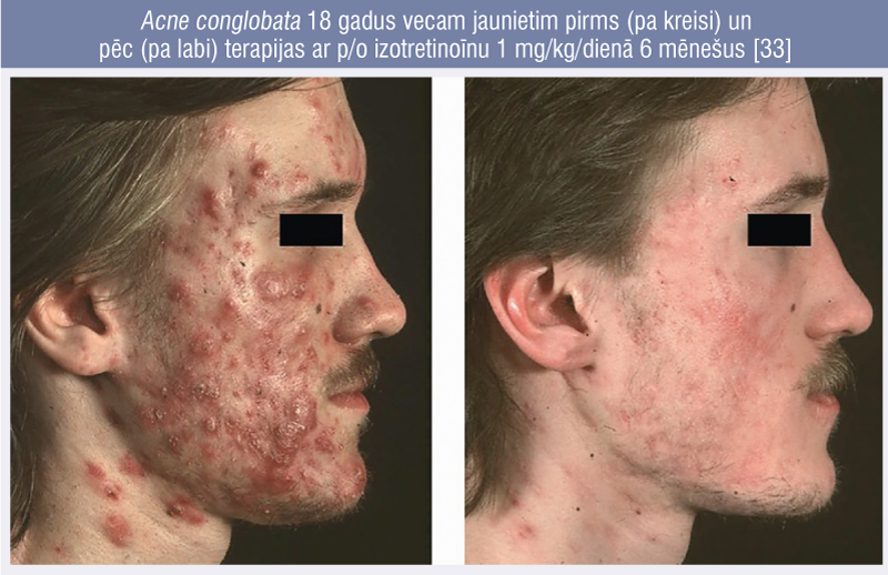 Acne conglobata 18 gadus vecam jaunietim pirms (pa kreisi) un 
pēc (pa labi) terapijas ar p/o izotretinoīnu 1 mg/kg/dienā 6 mēnešus [33]