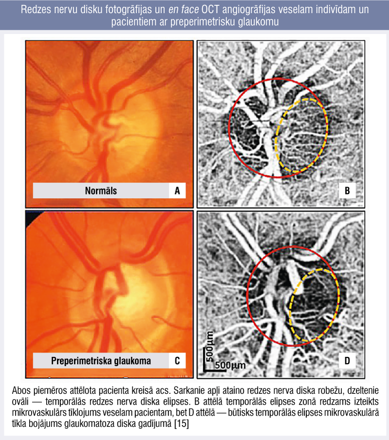 Redzes nervu disku fotogrāfijas un en face OCT angiogrāfijas veselam indivīdam un pacientiem ar preperimetrisku glaukomu