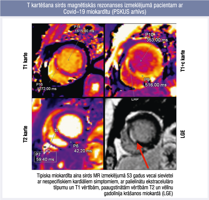 T kartēšana sirds magnētiskās rezonanses izmeklējumā pacientam ar 
Covid–19 miokardītu (PSKUS arhīvs)