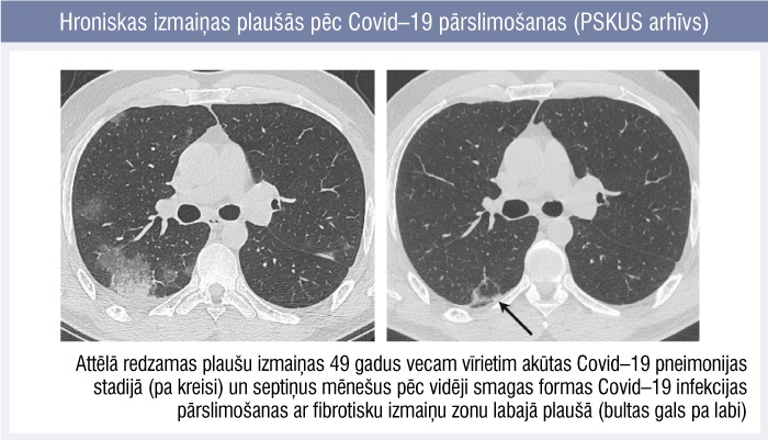 Hroniskas izmaiņas plaušās pēc Covid–19 pārslimošanas (PSKUS arhīvs)