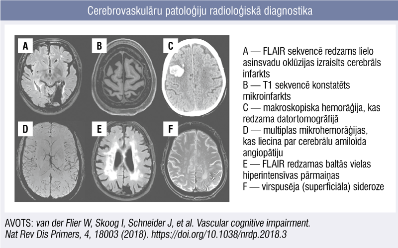 Cerebrovaskulāru patoloģiju radioloģiskā diagnostika