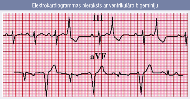 Elektrokardiogrammas pieraksts ar ventrikulāro bigeminiju