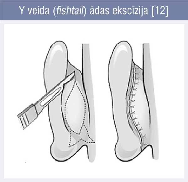 Y veida (fishtail) ādas ekscīzija [12]
