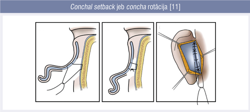 Conchal setback jeb concha rotācija [11]