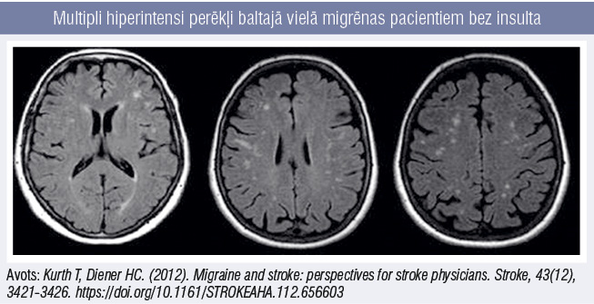 Multipli hiperintensi perēkļi baltajā vielā migrēnas pacientiem bez insulta