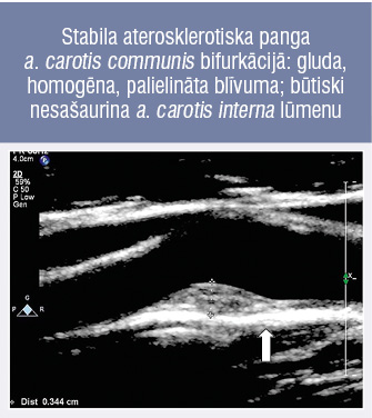Stabila aterosklerotiska panga a. carotis communis bifurkācijā: gluda, homogēna, palielināta blīvuma; būtiski nesašaurina a. carotis interna lūmenu