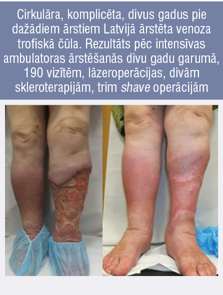 Cirkulāra, komplicēta, divus gadus pie dažādiem ārstiem Latvijā ārstēta venoza trofiskā čūla. Rezultāts pēc intensīvas ambulatoras ārstēšanās divu gadu garumā, 190 vizītēm, lāzeroperācijas, divām skleroterapijām, trim shave operācijām