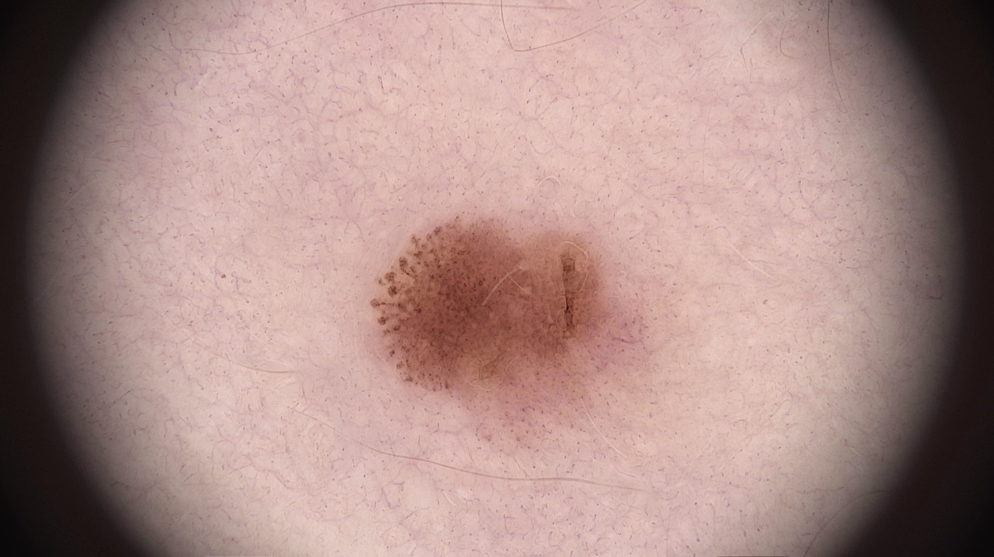 Pigmentēta melanoma in situ līdz 4 mm diametrā ar dermatoskopiski redzamu struktūras asimetriju, ko veido tikai pseidopodijas veidojuma kreisajā pusē jeb strēles ar apaļas formas globulām to galā
