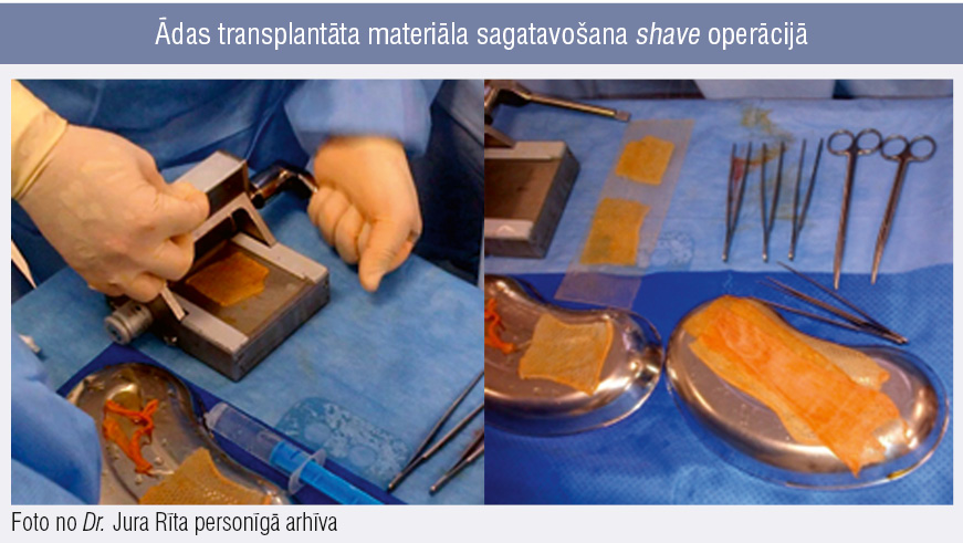 Ādas transplantāta materiāla sagatavošana shave operācijā