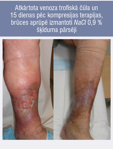 Atkārtota venoza trofiskā čūla un 15 dienas pēc kompresijas terapijas, brūces aprūpē izmantoti NaCl 0,9 % šķīduma pārsēji