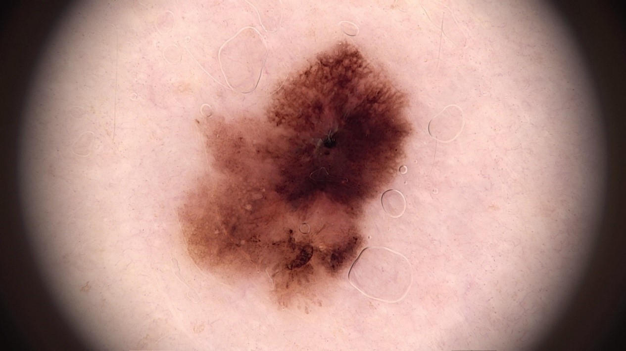 Pigmentēta melanoma in situ 6 × 7 mm diametrā ar izteiktākām dermatoskopiskām pazīmēm. Dermatoskopiski redzama struktūras un krāsas asimetrija, neregulārs tīklojums un veidojuma lejasdaļā arī strēlēm līdzīgas struktūras