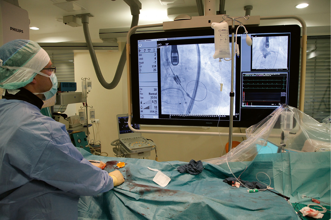 Transkatetrāla aortas vārstuļa implantācija caur cirkšņa artēriju