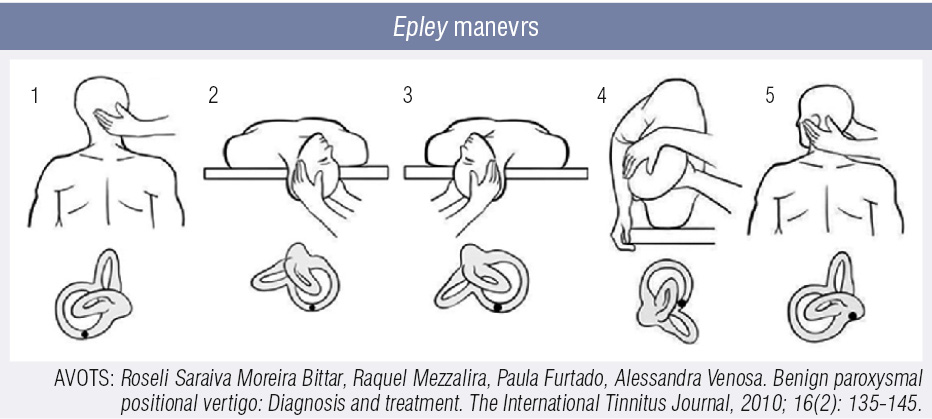 Epley manevrs