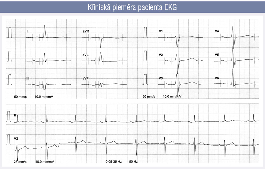 Klīniskā piemēra pacienta EKG