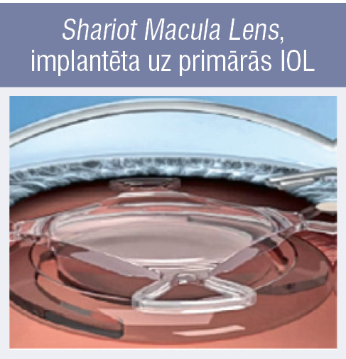 Shariot Macula Lens, implantēta uz primārās IOL