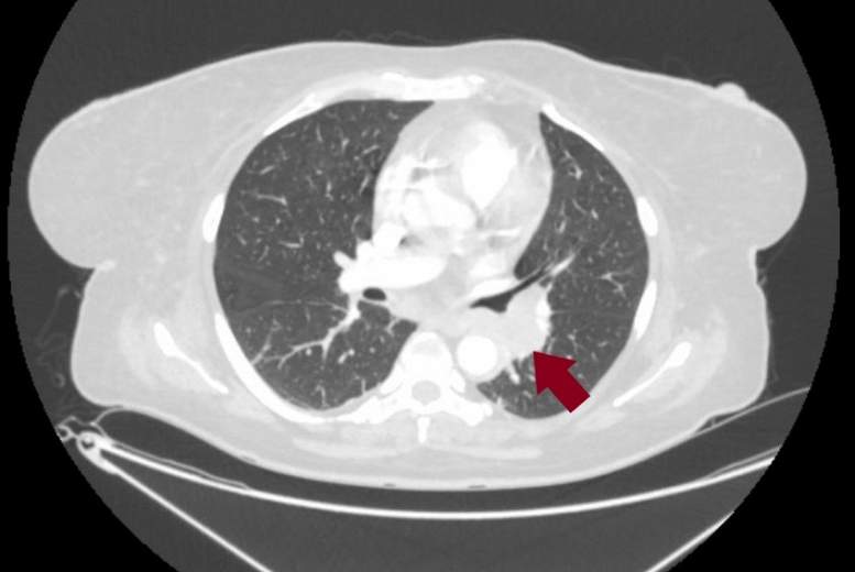 Ektopiska AKTH sekrēcija plaušu sīkšūnu vēža gadījumā