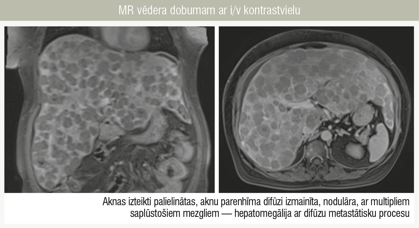 MR vēdera dobumam ar i/v kontrastvielu