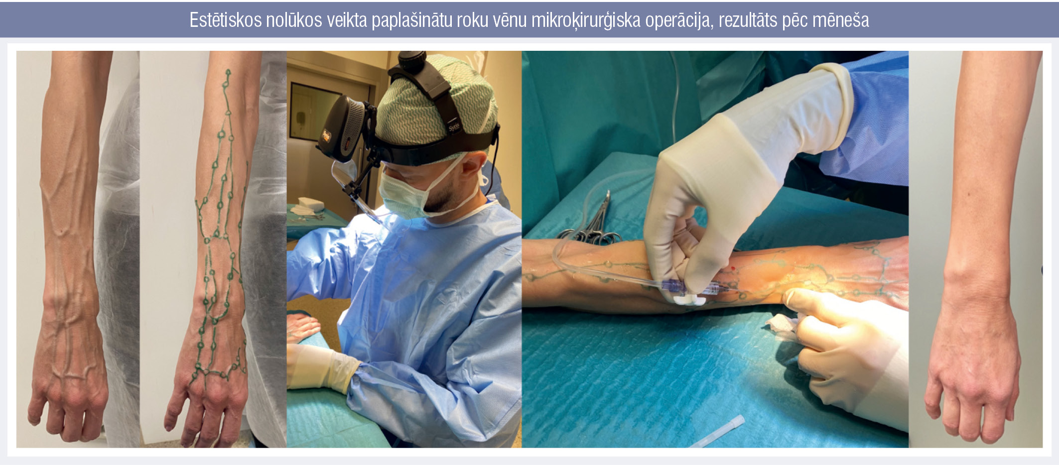 Estētiskos nolūkos veikta paplašinātu roku vēnu mikroķirurģiska operācija, rezultāts pēc mēneša