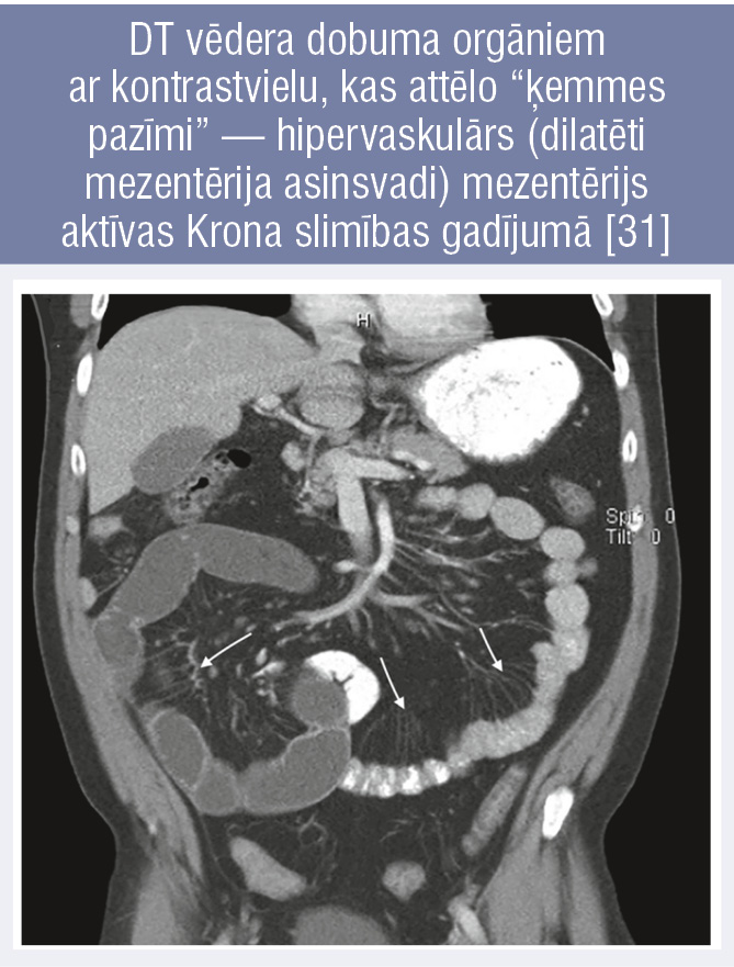 DT vēdera dobuma orgāniem ar kontrastvielu, kas attēlo “ķemmes pazīmi” — hipervaskulārs (dilatēti mezentērija asinsvadi) mezentērijs aktīvas Krona slimības gadījumā [31]