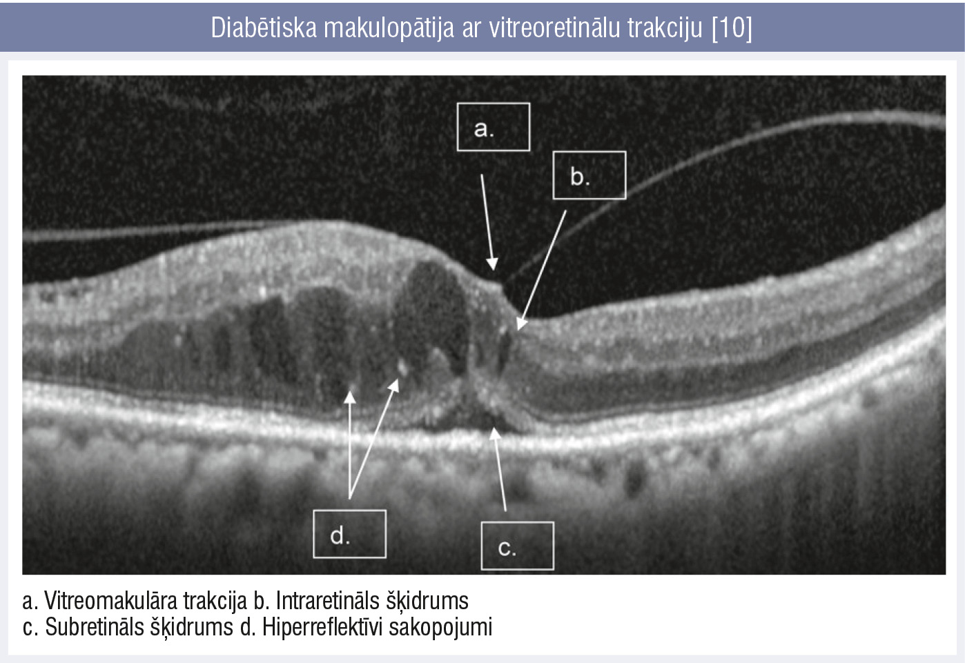 Diabētiska makulopātija ar vitreoretinālu trakciju [10]