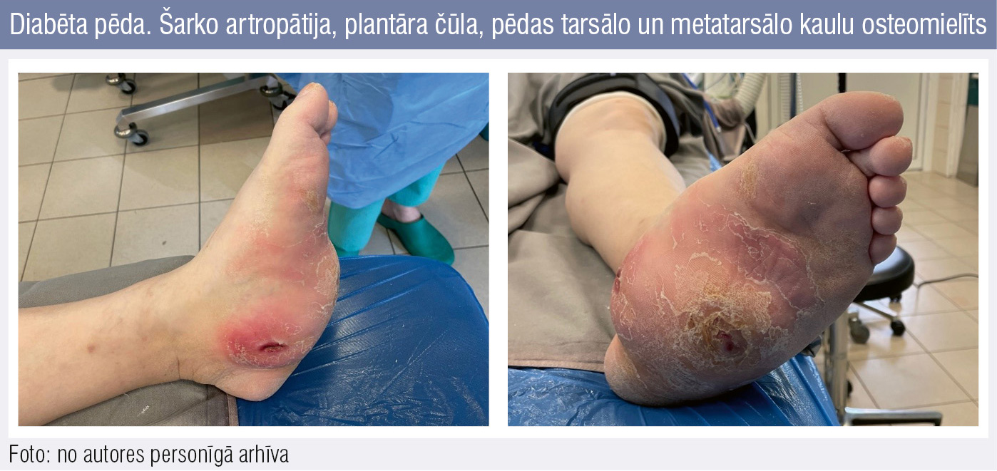 Diabēta pēda. Šarko artropātija, plantāra čūla, pēdas tarsālo un metatarsālo kaulu osteomielīts