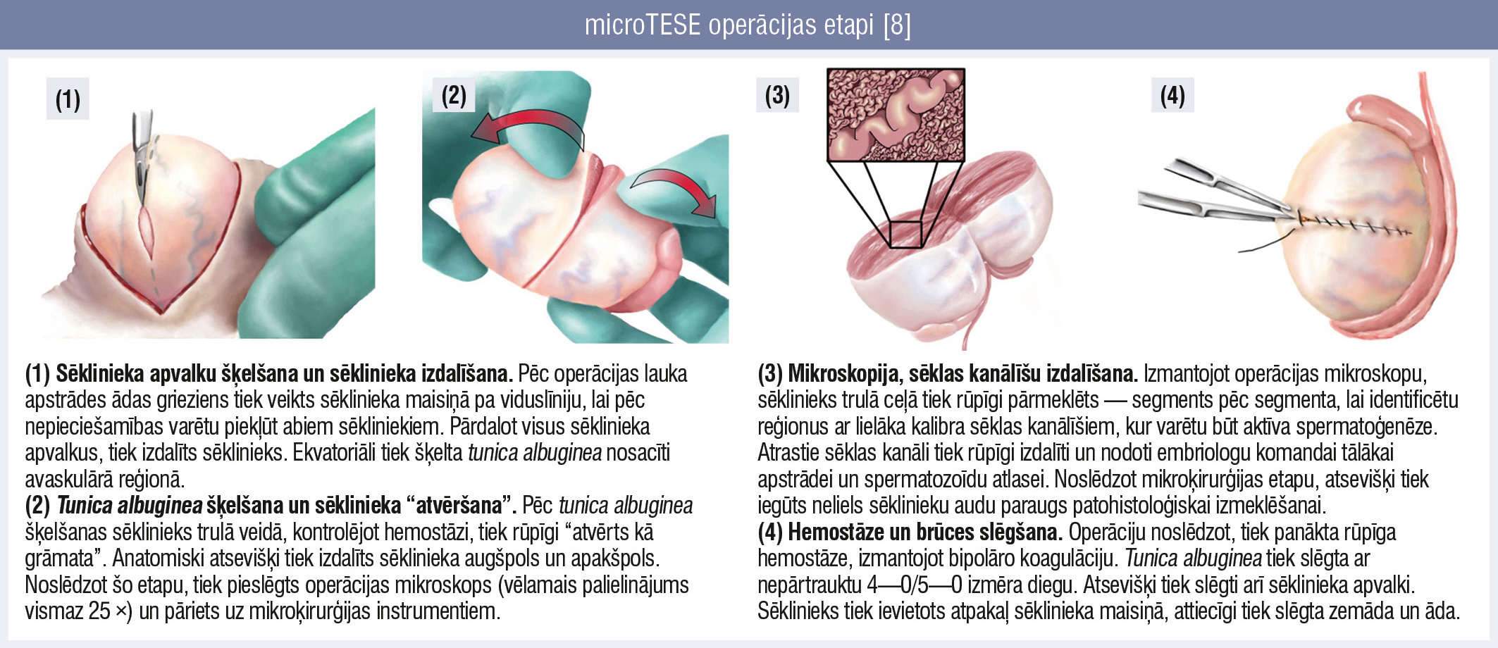 microTESE operācijas etapi [8]