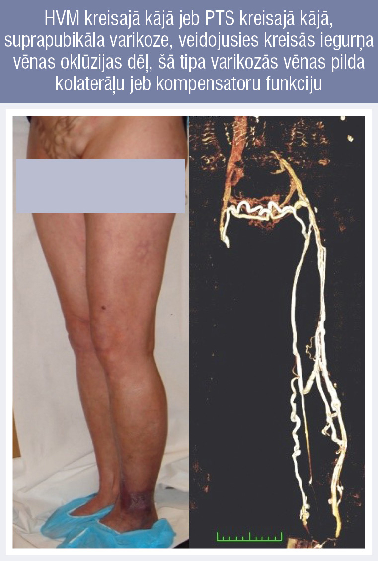 HVM kreisajā kājā jeb PTS kreisajā kājā, suprapubikāla varikoze, veidojusies kreisās iegurņa vēnas oklūzijas dēļ, šā tipa varikozās vēnas pilda kolaterāļu jeb kompensatoru funkciju