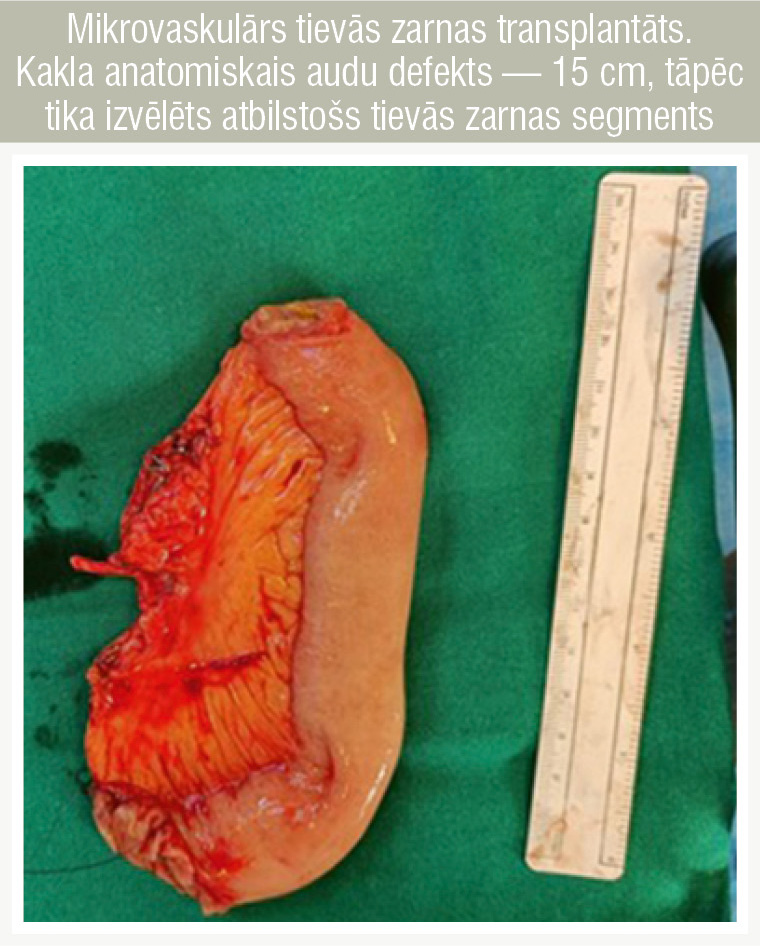 Mikrovaskulārs tievās zarnas transplantāts. Kakla anatomiskais audu defekts — 15 cm, tāpēc tika izvēlēts atbilstošs tievās zarnas segments