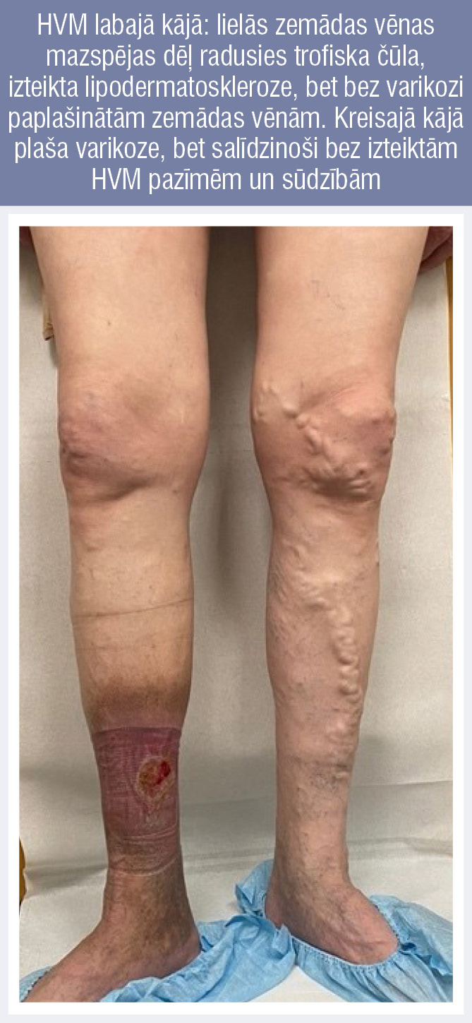 HVM labajā kājā: lielās zemādas vēnas mazspējas dēļ radusies trofiska čūla, izteikta lipodermatoskleroze, bet bez varikozi paplašinātām zemādas vēnām. Kreisajā kājā plaša varikoze, bet salīdzinoši bez izteiktām HVM pazīmēm un sūdzībām