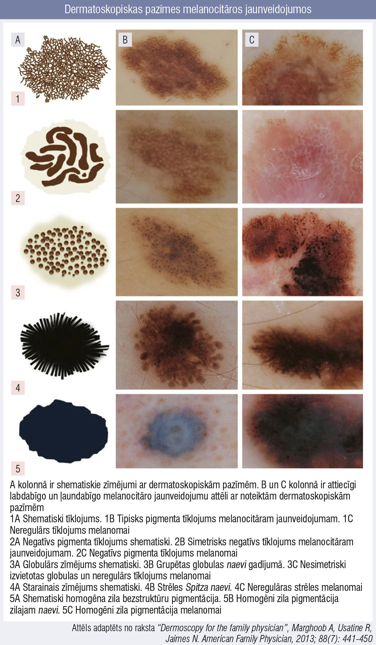 Dermatoskopiskas pazīmes melanocitāros jaunveidojumos