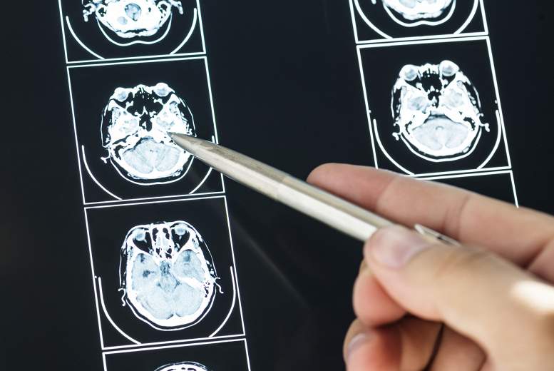 Smadzeņu satricinājumi jaunībā var būt saistīti ar kognitīvo spēju samazināšanos vēlīnā vecumā