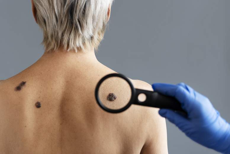 Nemelanomas ādas vēzis ir nāves cēlonis vairāk cilvēku nekā melanoma