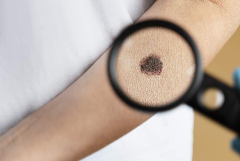 Pacientiem ar aktīnisko keratozi ir paaugstināts ādas vēža risks