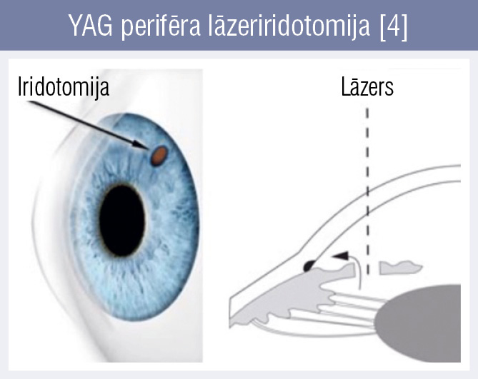 YAG perifēra lāzeriridotomija [4]