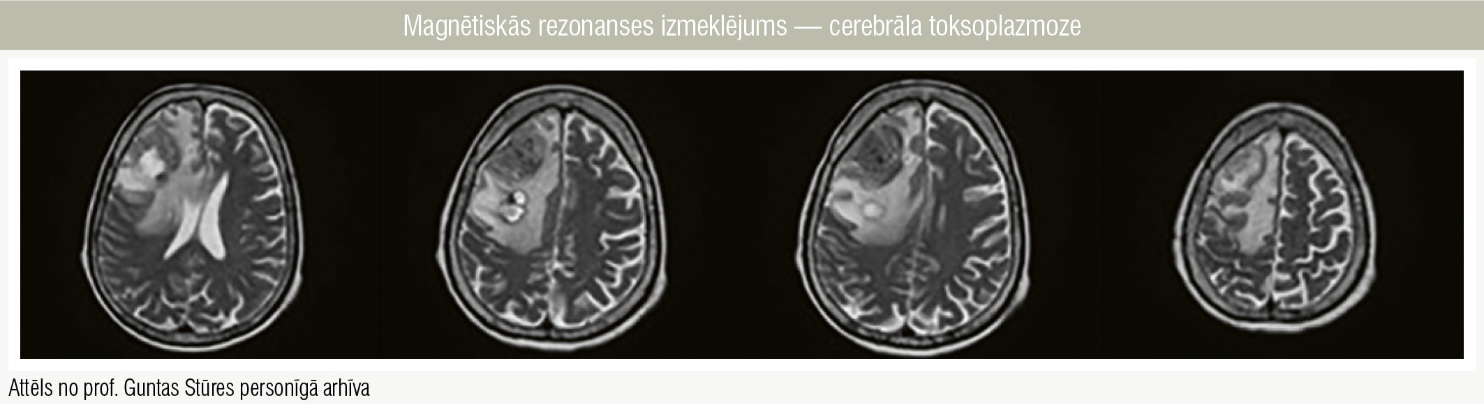 Magnētiskās rezonanses izmeklējums — cerebrāla toksoplazmoze