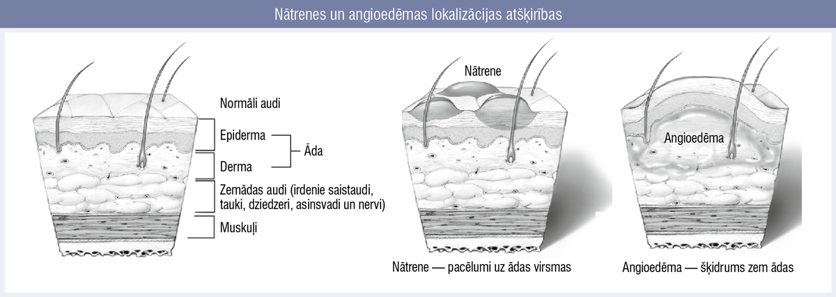 Nātrenes un angioedēmas lokalizācijas atšķirības