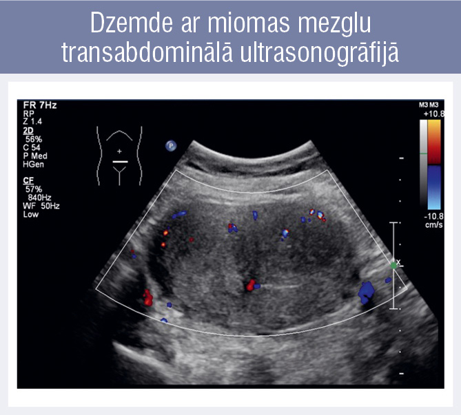 Dzemde ar miomas mezglu 
transabdominālā ultrasonogrāfijā