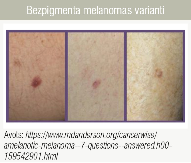 Bezpigmenta melanomas varianti