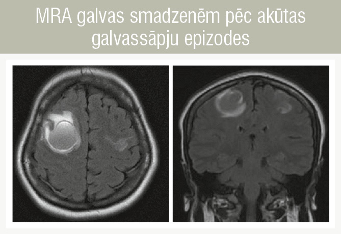 MRA galvas smadzenēm pēc akūtas galvassāpju epizodes