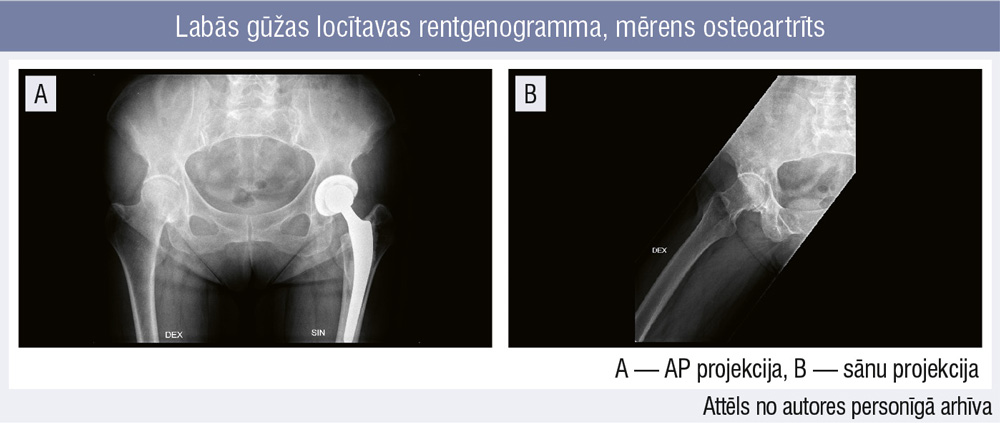 Labās gūžas locītavas rentgenogramma, mērens osteoartrīts