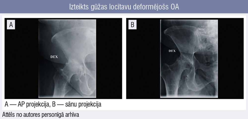 Izteikts gūžas locītavu deformējošs OA