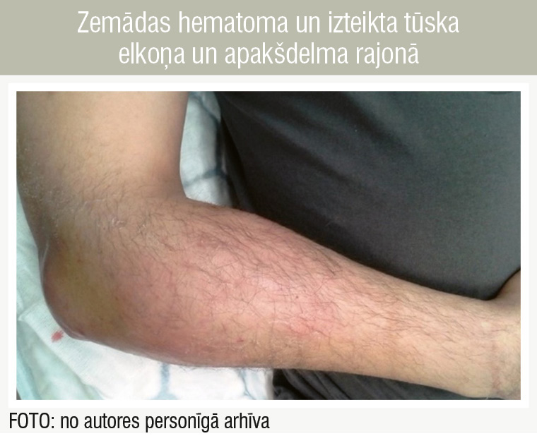 Zemādas hematoma un izteikta tūska elkoņa un apakšdelma rajonā