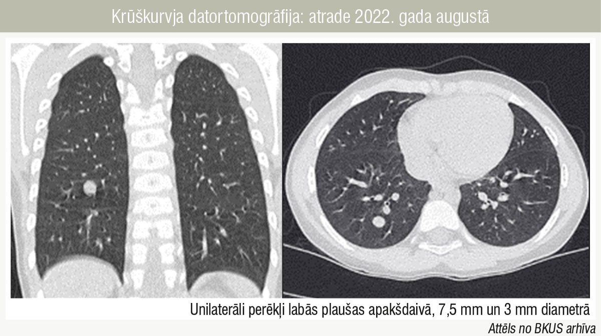 Krūškurvja datortomogrāfija: atrade 2022. gada augustā